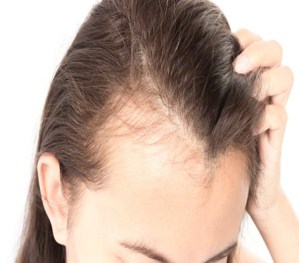 Hair Loss: 10 Causes, Treatment and Prevention