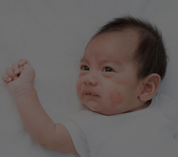Common Skin Problems in Newborn Baby