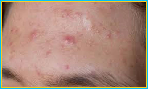 Non- Inflammatory Acne Treatment in Hyderabad