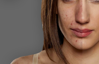 Preventing Acne & Acne Scars in Hyderabad