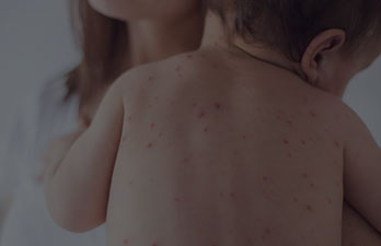 Skin Problems In Kids and Treatment