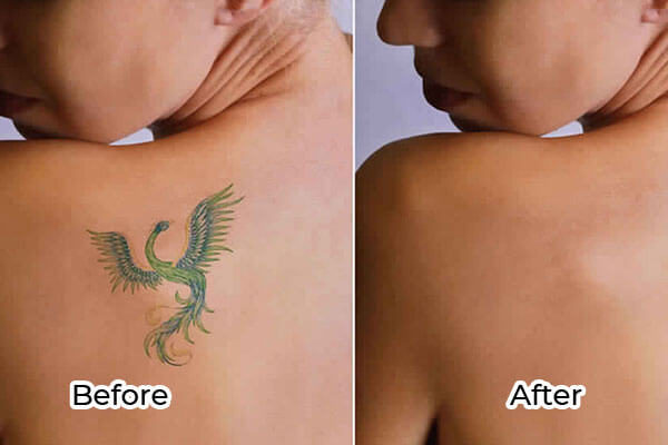 How To Remove Permanent Tattoos 4 Surgical Methods And 6 DIYs
