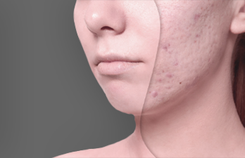 Acne and Acne Scars Treatment in Hyderabad