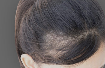Androgenetic Alopecia Treatment in Hyderabad