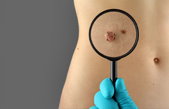 Moles and Skin Tags Treatment in Hyderabad